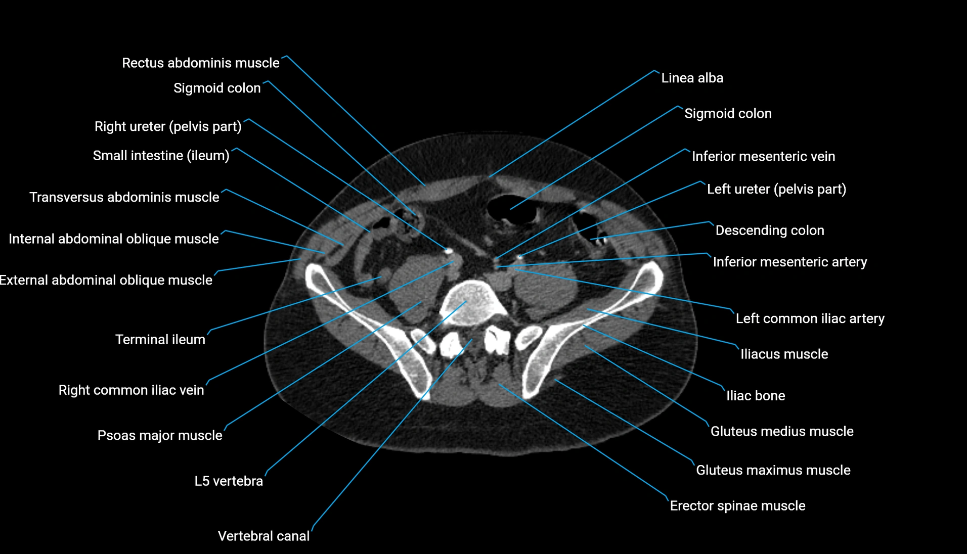 CT urogram axial cross sectional anatomy  labelled radiology image-00173.webp